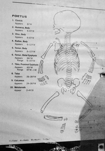 Foetus